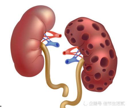 肾衰竭可以吃熏瓜吗视频,专家解读与建议
